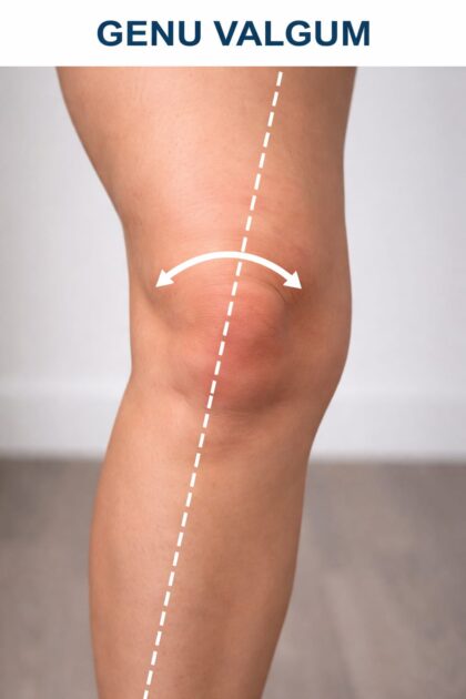 Genu Valgum Brace